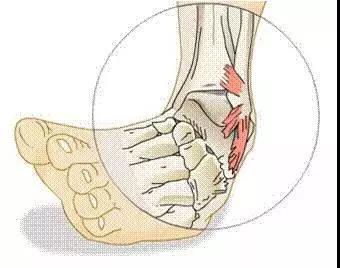 脚踝扭伤两个月仍肿胀，原因分析及康复建议